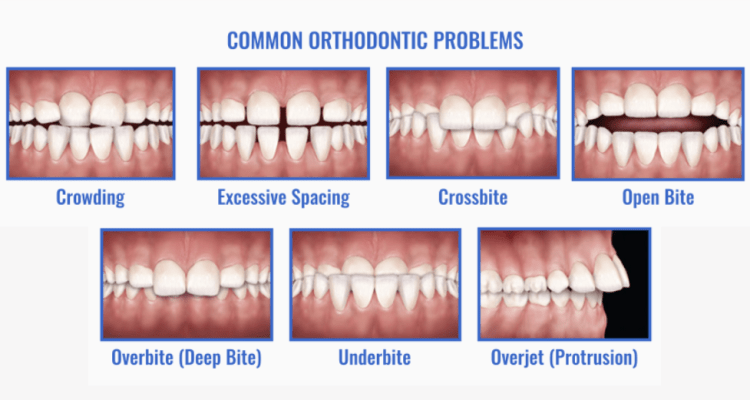 Common Orthodontic Issues