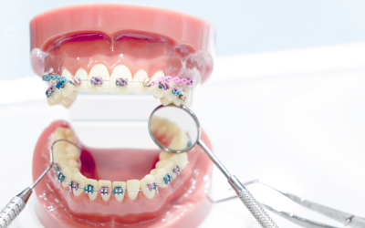 Tips for Braces Care and Hygiene