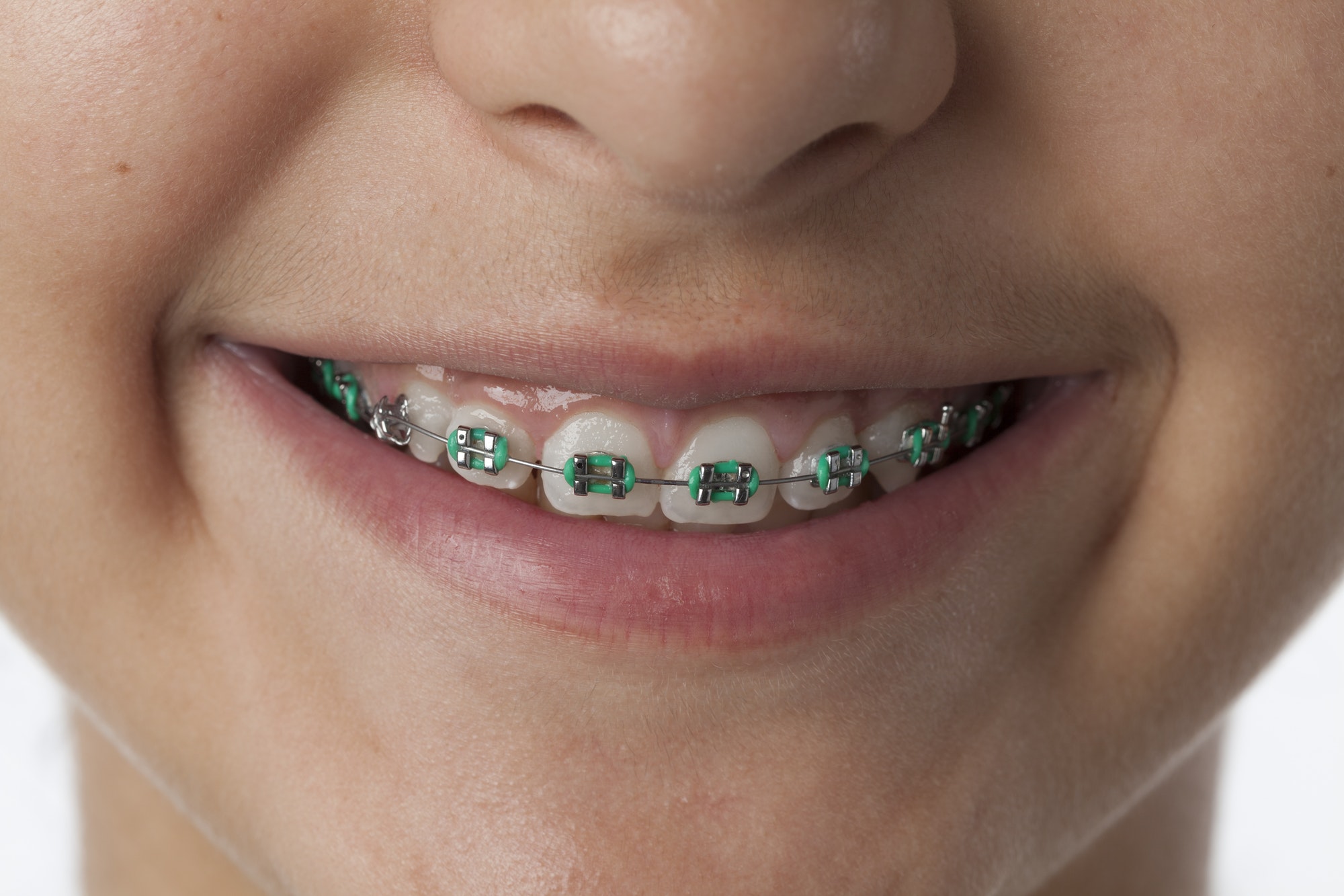 Orthodontic Bands: What They Are and How They Work