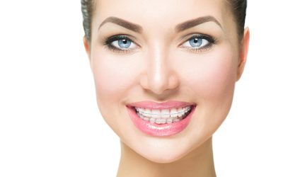 What Are Invisible Braces?